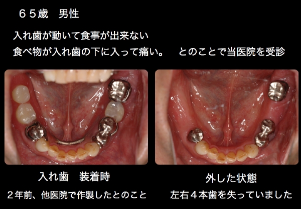 インプラント２.tiff