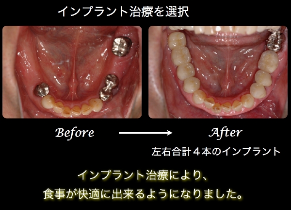 インプラント1.tiff